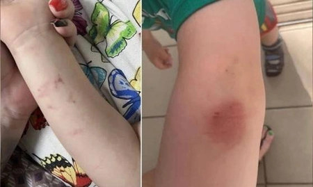 Избиение в Балашихе: ребенку с ДЦП в детском саду нанесли телесные повреждения